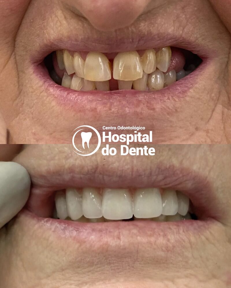 Antes e depois de reabilitação estética com facetas e coroas no Centro Odontológico Hospital do Dente