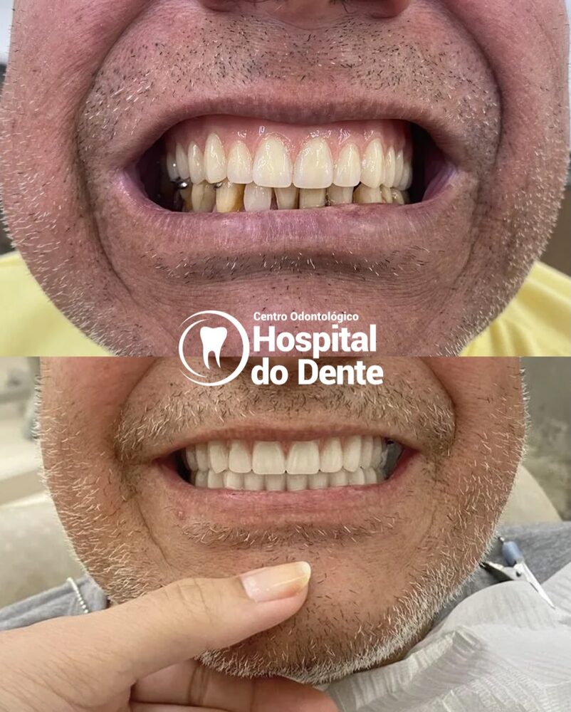 Antes e depois de prótese fixa sobre implantes no Centro Odontológico Hospital do Dente em Campos Novos