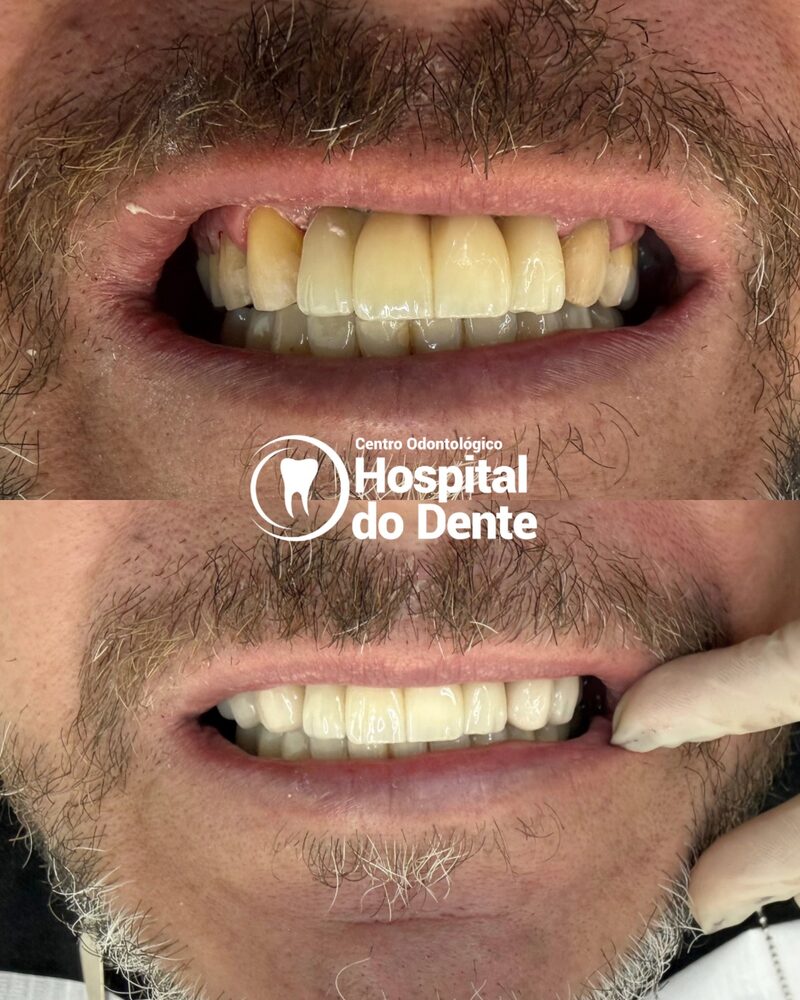 Antes e depois de reabilitação oral completa com implantes dentários em Campos Novos