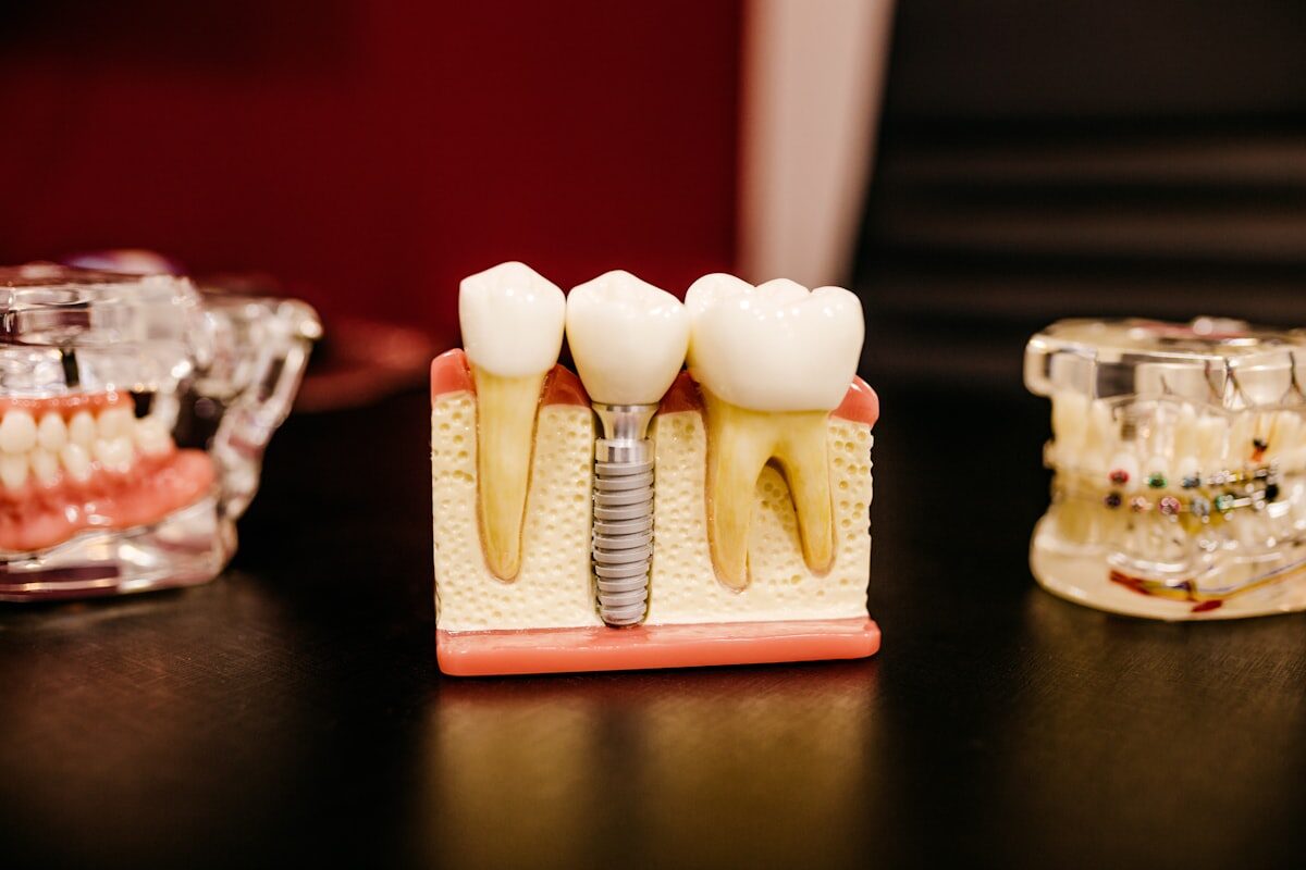 Modelo de implante dentário